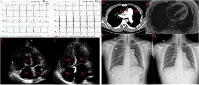 Leflunomide-induced pulmonary arterial hypertension in a young man with nephrotic syndrome: A case report